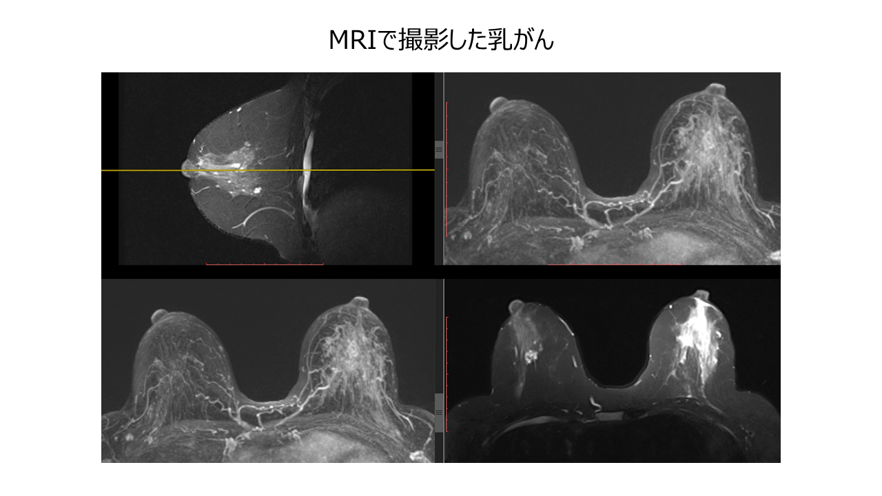 造影 ct で 見つかる 乳がん