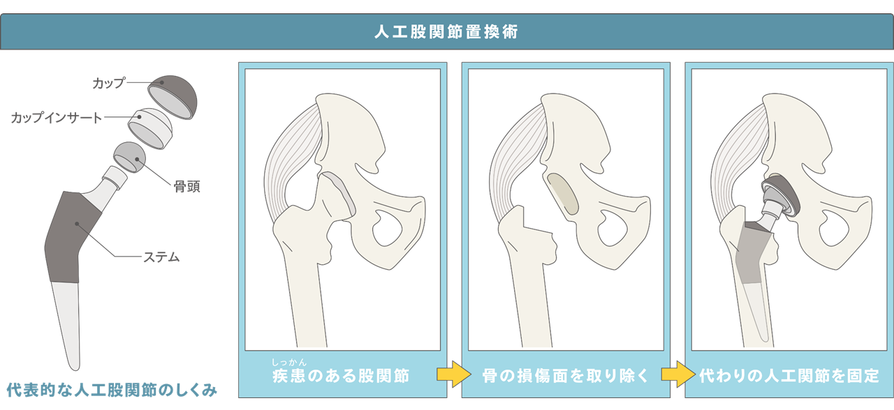 人工股関節置換術が必要になる兆候は何ですか?